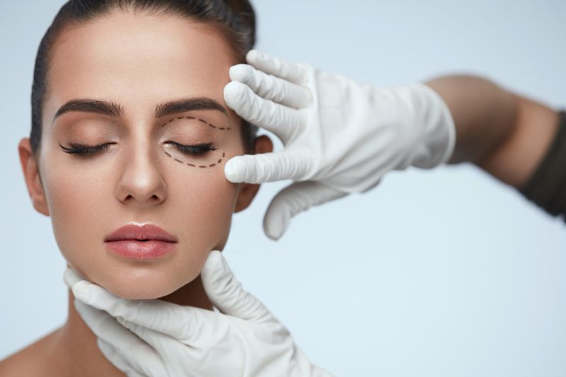 Upper Blepharoplasty